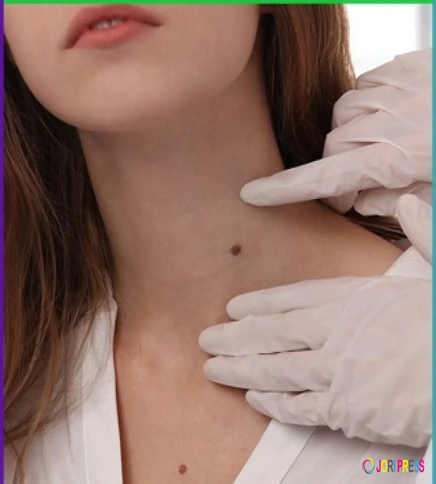 Birthmark Removal in Dubai: Restore Your Skin Confidence