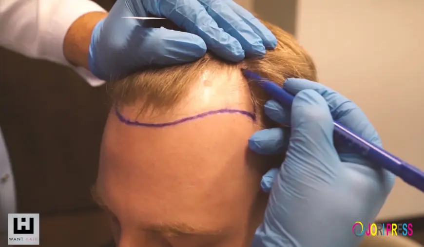 Redefining Hair Restoration Standards at the Best FUE Hair Transplant Clinic in Turkey