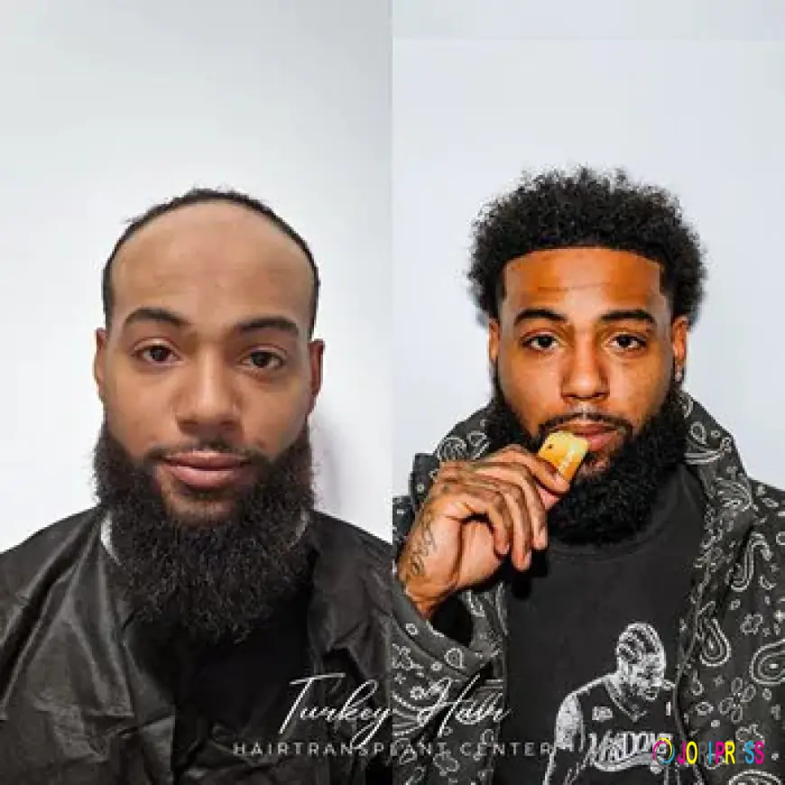 Why Afro Hair Transplant Requires Specialized Expertise