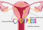 Laparoscopic Surgery For Fibroids in Chennai: A Modern Solution for Women’s Health