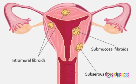 Laparoscopic Surgery For Fibroids in Chennai: A Modern Solution for Women’s Health