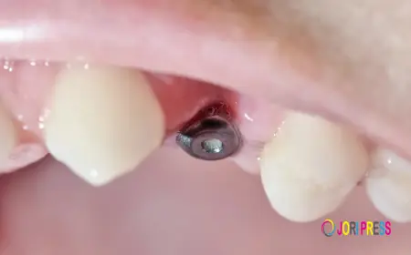 How Dental Implants in League City Complement Invisalign Treatment?