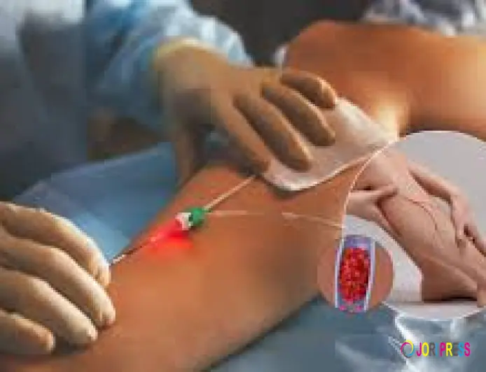 Best Varicose Veins Treatment in Toronto for Lasting Relief