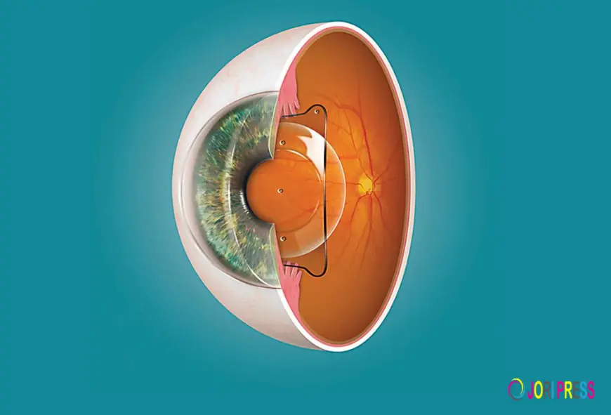 The Implantable Collamer Lens Market Insights Highlighting Technological Advancements And Consumer Adoption Globally