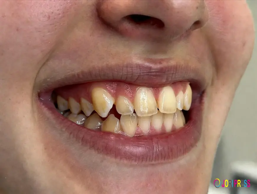 Top Signs You Need Orthodontic Treatment