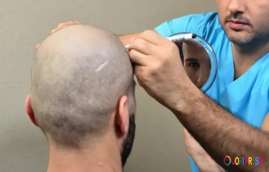 كل ما تريد معرفته عن زراعة الشعر وكيف يمكن أن ت