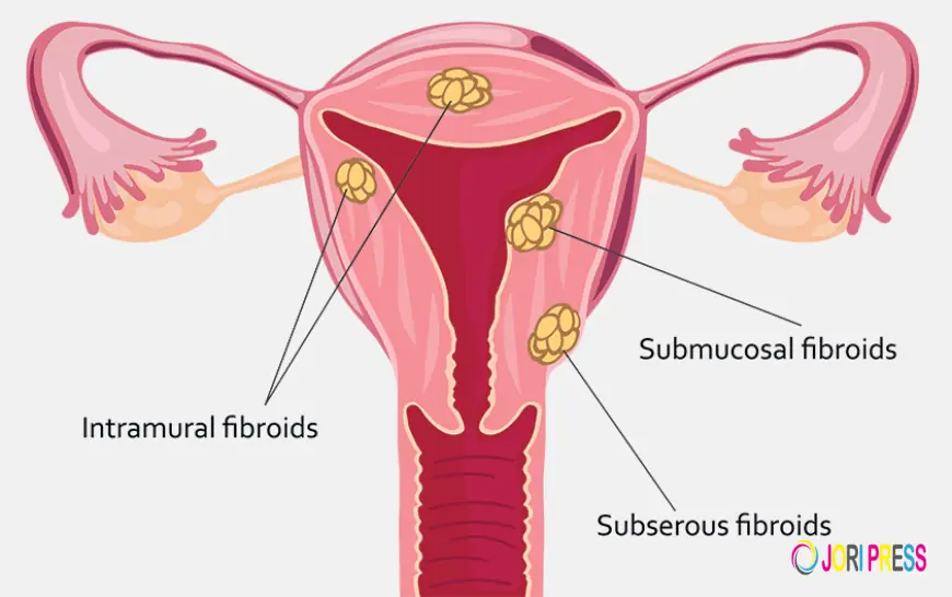 Laparoscopic Surgery For Fibroids in Chennai: A Modern Solution for Women’s Health