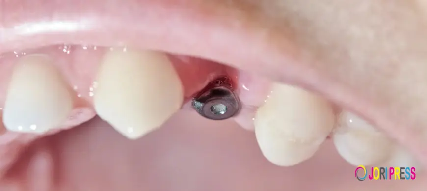 How Dental Implants in League City Complement Invisalign Treatment?