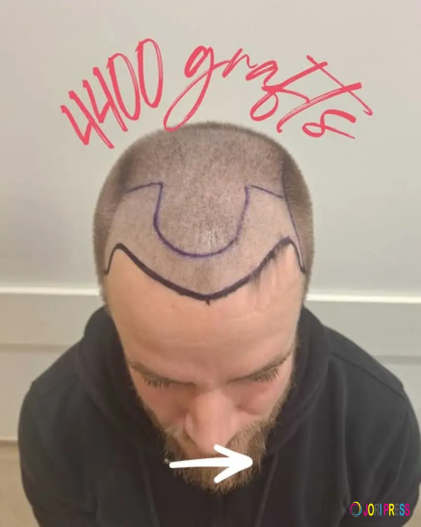 Want Hair Ltd: The Trusted Name for Best Hair Transplant Surgery in Turkey