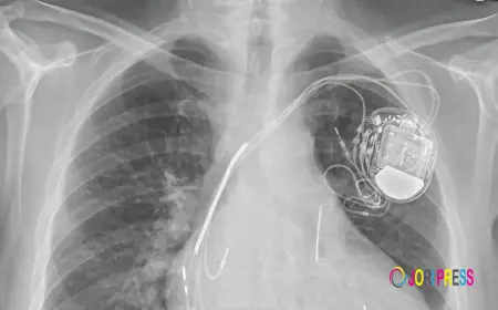 Atrial Fibrillation Device Market: Future Demand Driven by Innovation and Healthcare Expansion