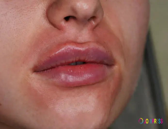 How to Reduce Bruising and Swelling After Lip Filler