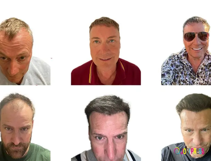 Want Hair Ltd Brings Advanced Hair Science to the Best Hair Transplant in the UK Market