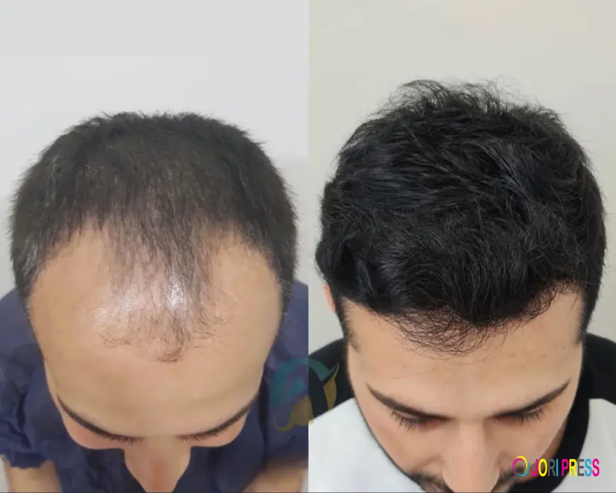 Top Hair Transplant Services in Islamabad