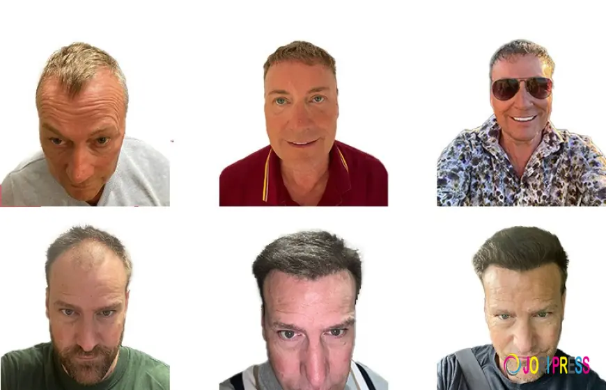 Want Hair Ltd Brings Advanced Hair Science to the Best Hair Transplant in the UK Market