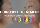Transform Your Confidence: Chin Lipo Treatment in Islamabad