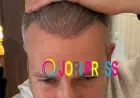 Best Hair Transplant Clinic in UK: Want Hair Ltd Focuses on Natural-Looking Hair Restoration