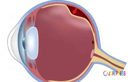 Top Reasons to Choose The Clinix for Retinal Detachment Treatment in Patiala