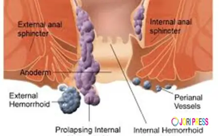 Comprehensive Guide to Hemorrhoids Bleeding Treatment and Care