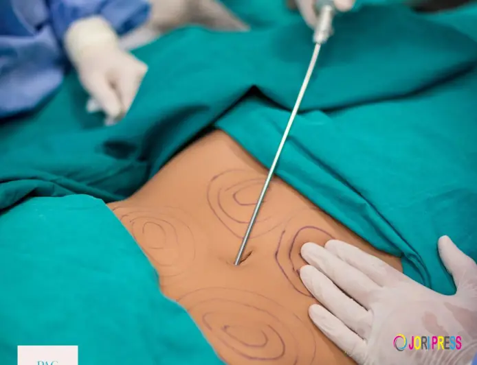 Liposuction in Islamabad – Sculpt Your Body with Expert Precision