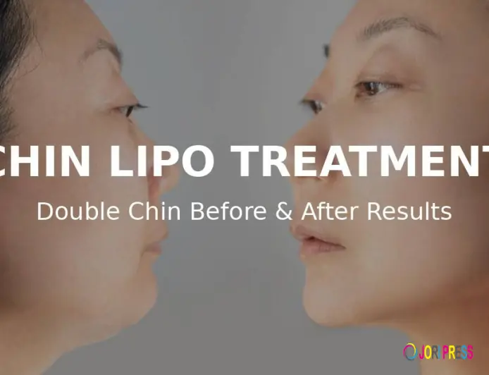Transform Your Confidence: Chin Lipo Treatment in Islamabad
