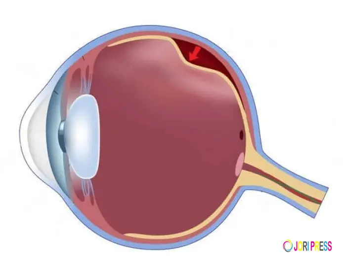 Top Reasons to Choose The Clinix for Retinal Detachment Treatment in Patiala