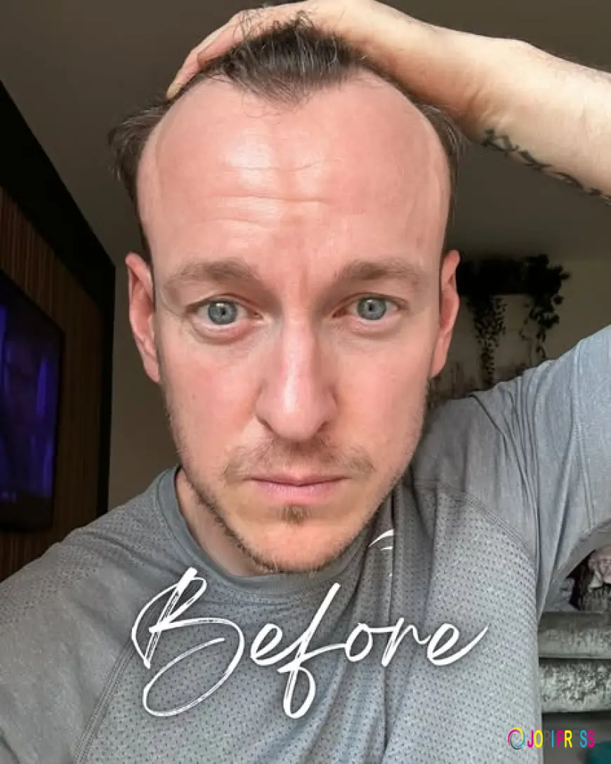 Want Hair Ltd Introduces Next-Generation Solutions for Best Hair Loss Treatment UK