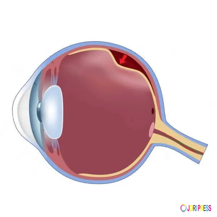 Top Reasons to Choose The Clinix for Retinal Detachment Treatment in Patiala