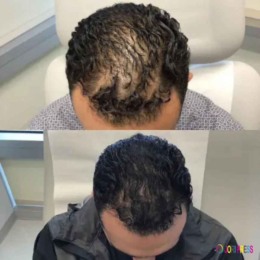 PRP Hair Treatment in Islamabad: Regrow Hair Naturally