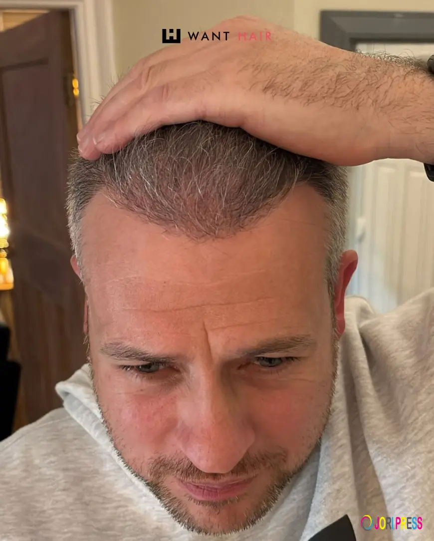 How Do Experts at Want Hair Ltd Deliver the Best Hair Transplant Surgery in Turkey?