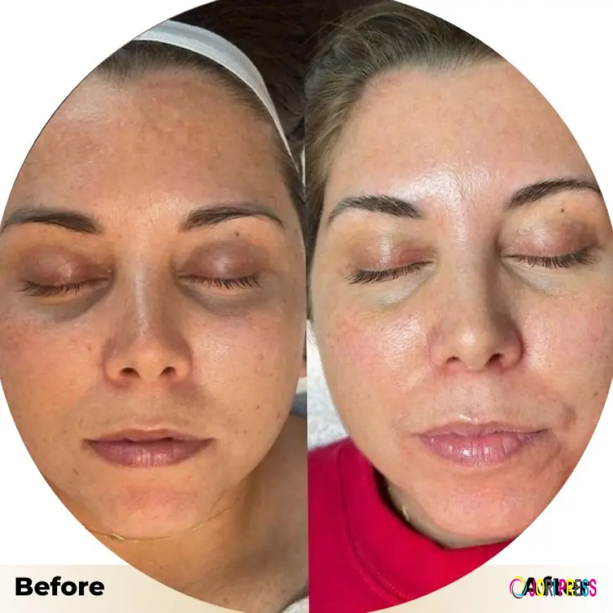 Hydrafacial in Islamabad: Achieve Radiant and Healthy Skin