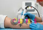 How Does Laser Tattoo Removal Work