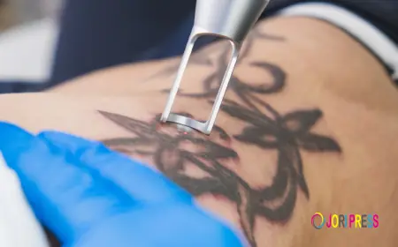 Tattoo Removal Cost What Factors Affect the Price