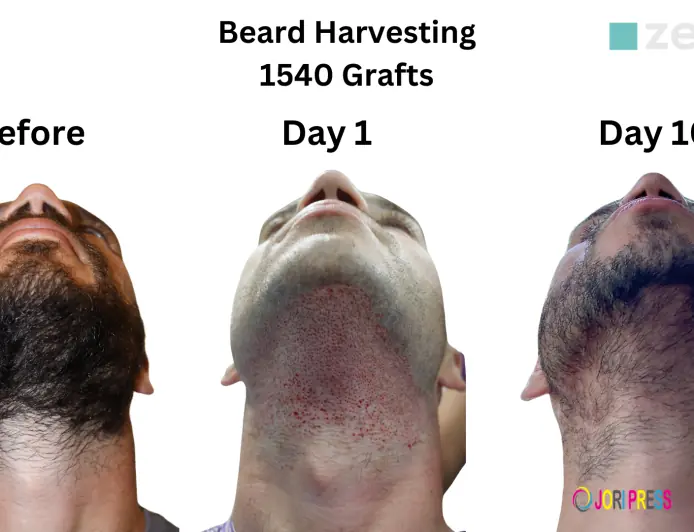 From Patchy to Full: How Beard Hair Transplants Transform Your Look