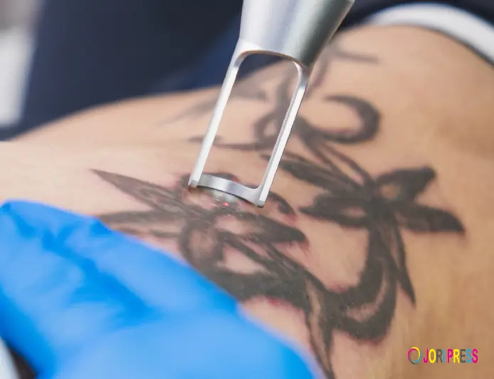 Tattoo Removal Cost What Factors Affect the Price