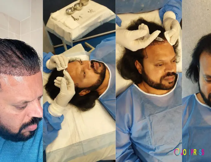 Balding at 30 in Pakistan? Here's Exactly How Much a Hair Transplant Will Cost You
