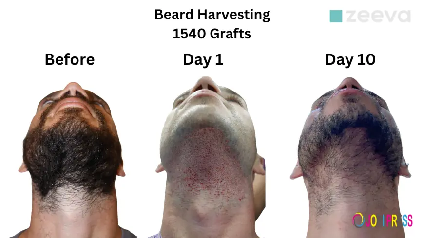 From Patchy to Full: How Beard Hair Transplants Transform Your Look