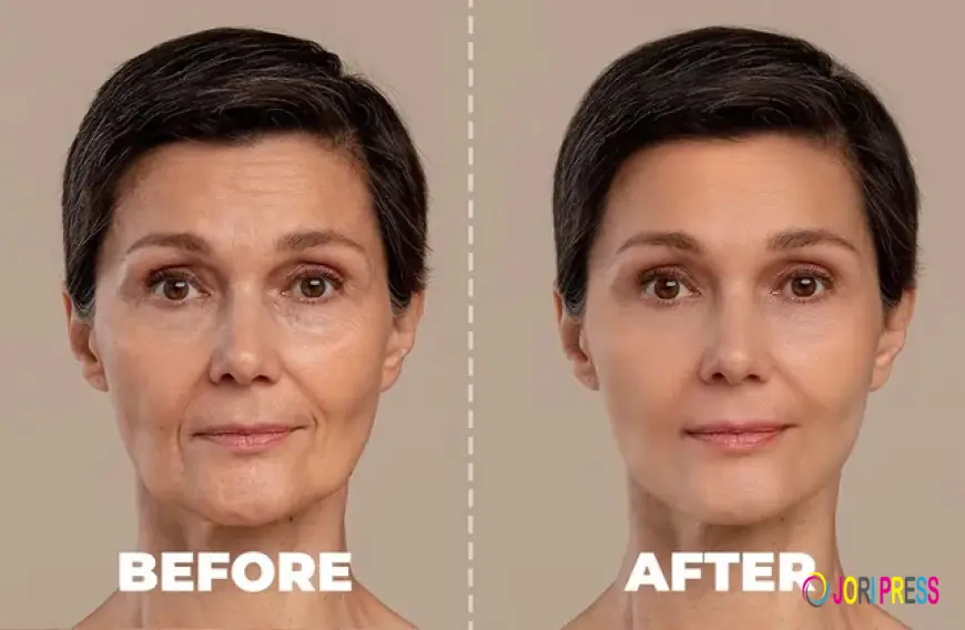 How Does Radiesse Dermal Filler Restore Volume and Smooth Wrinkles?