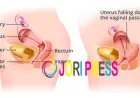Ayurvedic Treatment for Uterus Prolapse Without Surgery