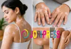 Vitiligo Treatment in Sharjah: What You Should Know Before Starting