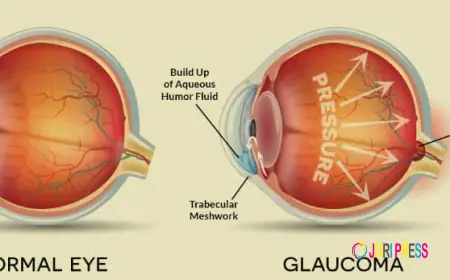 Advanced Eye Care and Glaucoma Treatment at Spectra Eye Hospital