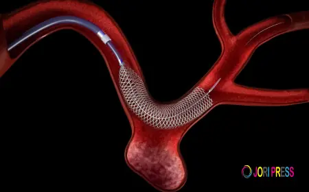 Flow Diverter: The Revolutionary Brain Aneurysm Treatment Changing Lives
