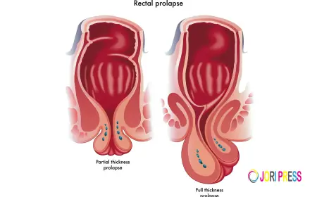 Ayurvedic Treatment for Rectal Prolapse Without Surgery