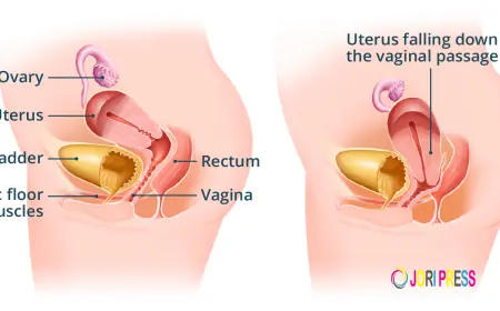Ayurvedic Treatment for Uterus Prolapse Without Surgery