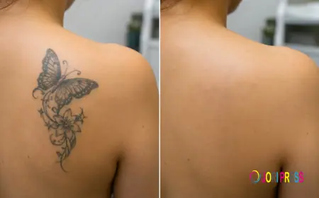 Laser Tattoo Removal in Sharjah: What You Should Know Before Starting
