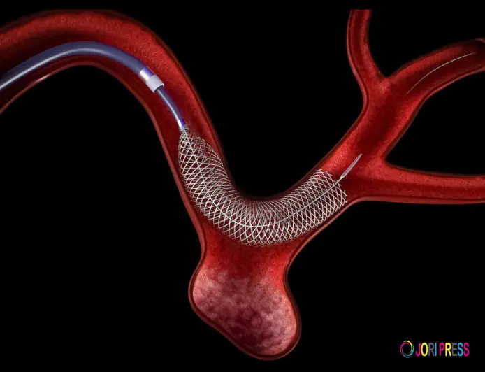 Flow Diverter: The Revolutionary Brain Aneurysm Treatment Changing Lives