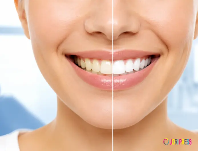 Professional Teeth Whitening Services in Sharjah: A Simple Guide to a Brighter Smile