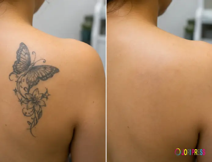 Laser Tattoo Removal in Sharjah: What You Should Know Before Starting