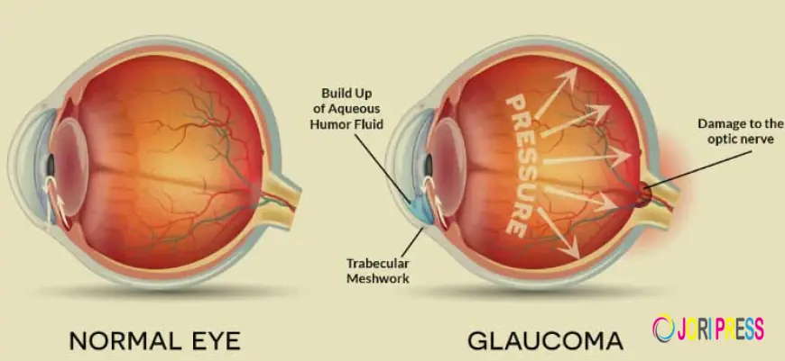 Advanced Eye Care and Glaucoma Treatment at Spectra Eye Hospital