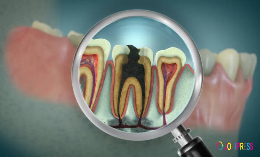 Root Canal Treatment In Chennai: How To Find A Trusted Dentist Near Me