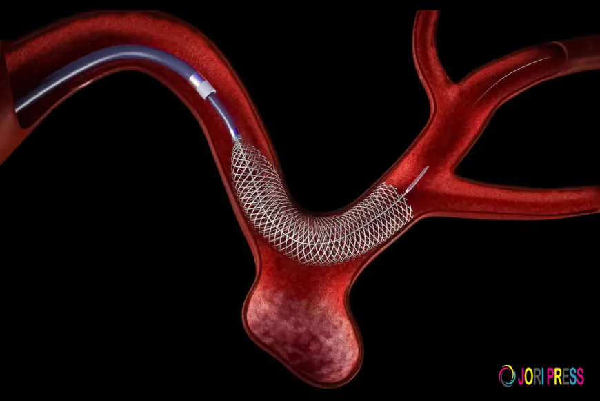 Flow Diverter: The Revolutionary Brain Aneurysm Treatment Changing Lives